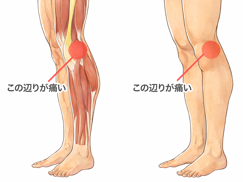 腸脛靭帯炎（ランナー膝）とは？