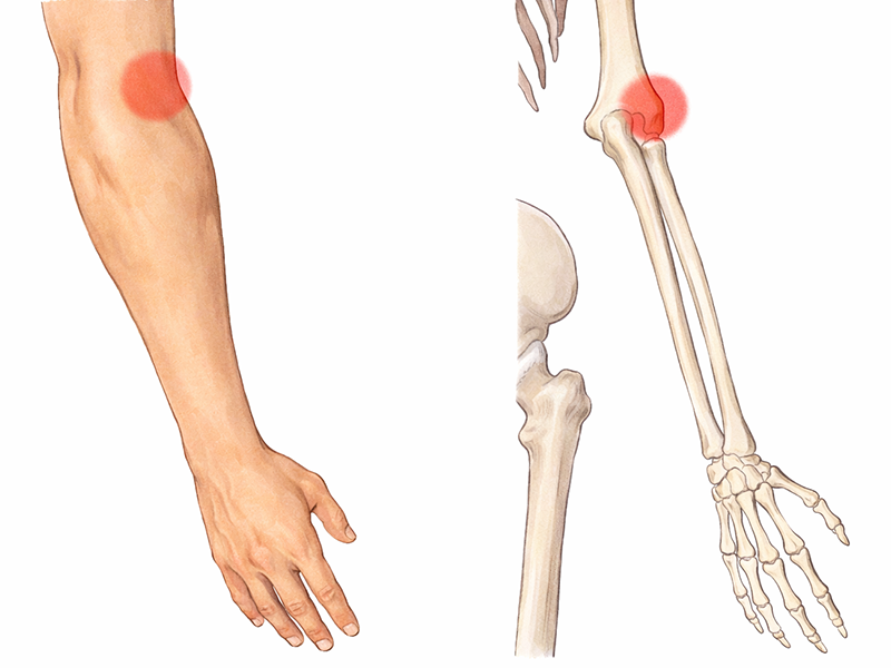 上腕骨外側上顆炎（テニス肘）とは？